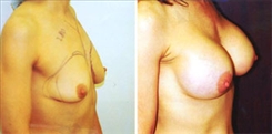 Breast Augmentation Patient Before & After Photo 1