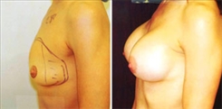 Breast Augmentation Patient Before & After Photo 1