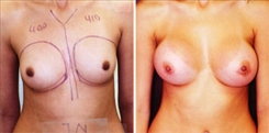 Breast Augmentation Patient Before & After Photo 1