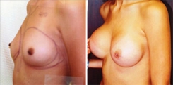 Breast Augmentation Patient Before & After Photo 1