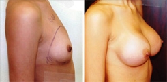 Breast Augmentation Patient Before & After Photo 1