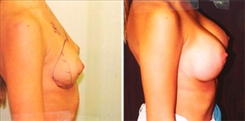 Breast Augmentation Patient Before & After Photo 1