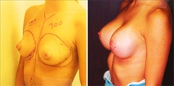 Breast Augmentation Patient Before & After Photo 1