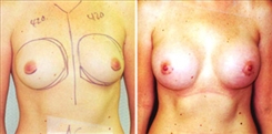 Breast Augmentation Patient Before & After Photo 1