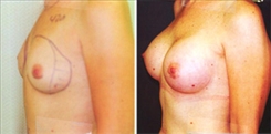 Breast Augmentation Patient Before & After Photo 1