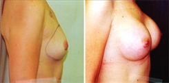 Breast Augmentation Patient Before & After Photo 1