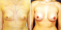 Breast Augmentation Patient Before & After Photo 1