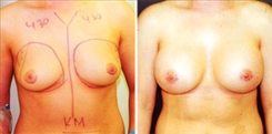 Breast Augmentation Patient Before & After Photo 1