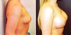 Breast Augmentation Patient Before & After Photo 1