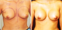 Breast Augmentation Patient Before & After Photo 1