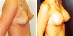 Breast Augmentation Patient Before & After Photo 1