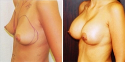 Breast Augmentation Patient Before & After Photo 1