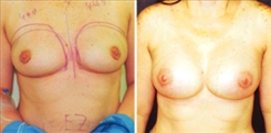 Breast Augmentation Patient Before & After Photo 1