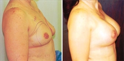 Breast Augmentation Patient Before & After Photo 1