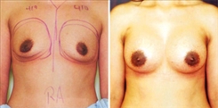 Breast Augmentation Patient Before & After Photo 1