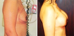 Breast Augmentation Patient Before & After Photo 1