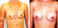 Breast Augmentation Patient Before & After Photo 1