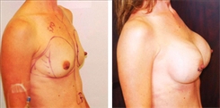 Breast Augmentation Patient Before & After Photo 1