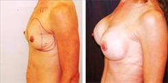 Breast Augmentation Patient Before & After Photo 1