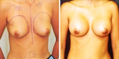 Breast Augmentation Patient Before & After Photo 1