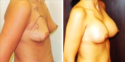 Breast Augmentation Patient Before & After Photo 1