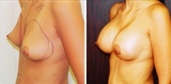 Breast Augmentation Patient Before & After Photo 1