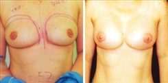 Breast Augmentation Patient Before & After Photo 1