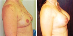 Breast Augmentation Patient Before & After Photo 1