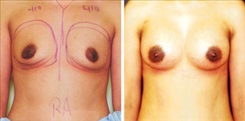 Breast Augmentation Patient Before & After Photo 1