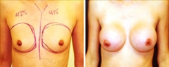 Breast Augmentation Patient Before & After Photo 1