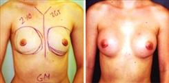 Breast Augmentation Patient Before & After Photo 1