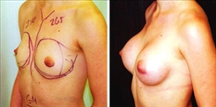 Breast Augmentation Patient Before & After Photo 1