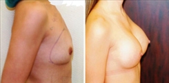 Breast Augmentation Patient Before & After Photo 1