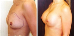 Breast Augmentation Patient Before & After Photo 1