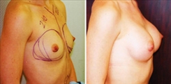 Breast Augmentation Patient Before & After Photo 1