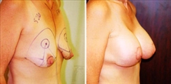 Breast Augmentation Patient Before & After Photo 1