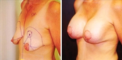 Breast Augmentation Patient Before & After Photo 1