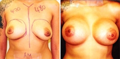 Breast Augmentation Patient Before & After Photo 1