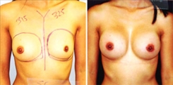 Breast Augmentation Patient Before & After Photo 1