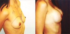 Breast Augmentation Patient Before & After Photo 1