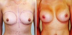 Breast Augmentation Patient Before & After Photo 1