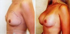 Breast Augmentation Patient Before & After Photo 1