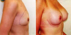 Breast Augmentation Patient Before & After Photo 1