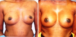 Breast Augmentation Patient Before & After Photo 1