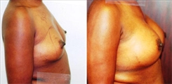 Breast Augmentation Patient Before & After Photo 1