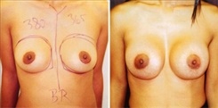 Breast Augmentation Patient Before & After Photo 1