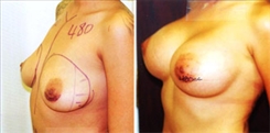 Breast Augmentation Patient Before & After Photo 1