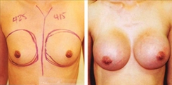 Breast Augmentation Patient Before & After Photo 1