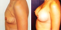 Breast Augmentation Patient Before & After Photo 1