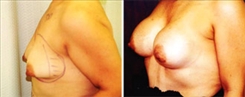 Breast Augmentation Patient Before & After Photo 1